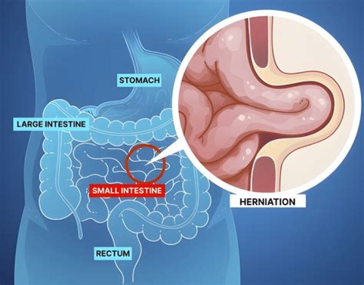 How do I check myself for a hernia?