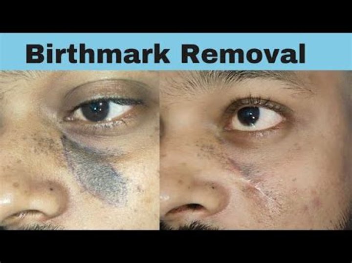 How do I get rid of birthmarks on my baby's face?