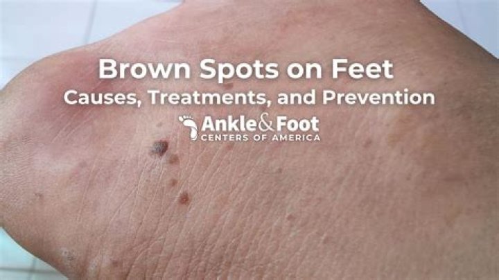 How do I get rid of brown spots on my skin?