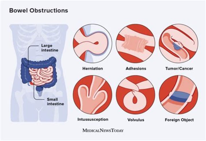 How do I know if my bowels are impacted?