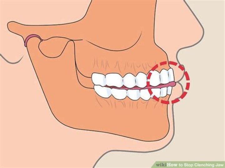 How do I stop clenching my jaw on Adderall?