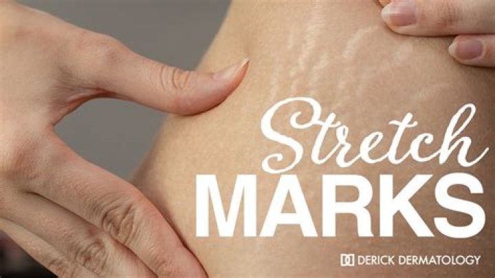 How do models get rid of stretch marks?