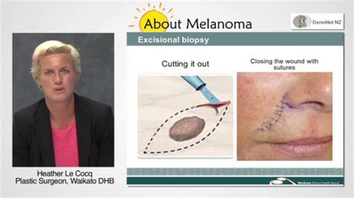 How do they biopsy melanoma?