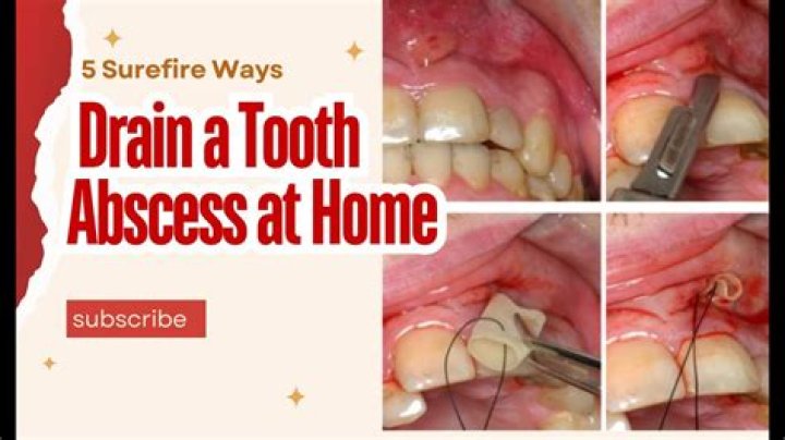 How do you drain a hard abscess at home?