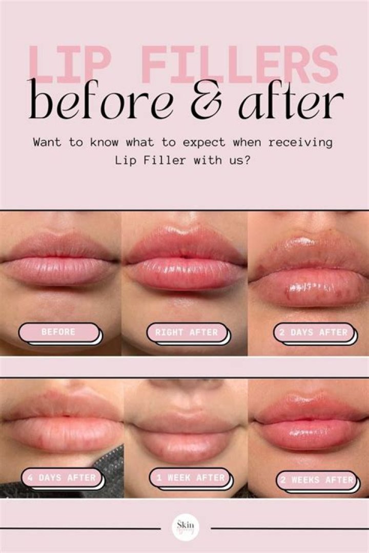 How do you eat with lip fillers?