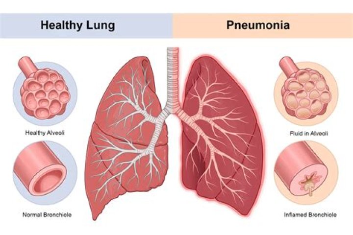 How do you fight pneumonia from Covid?