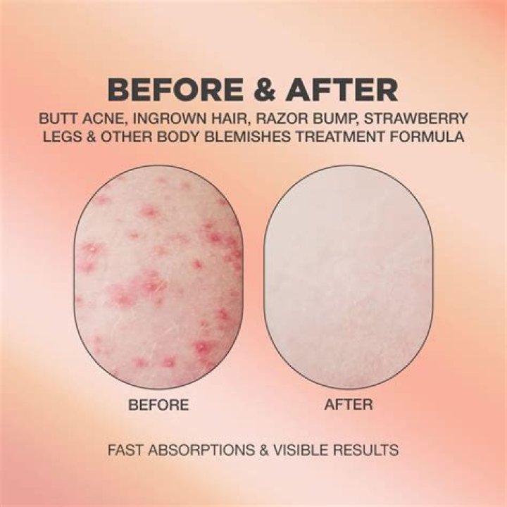 How do you get rid of butt rash in adults?