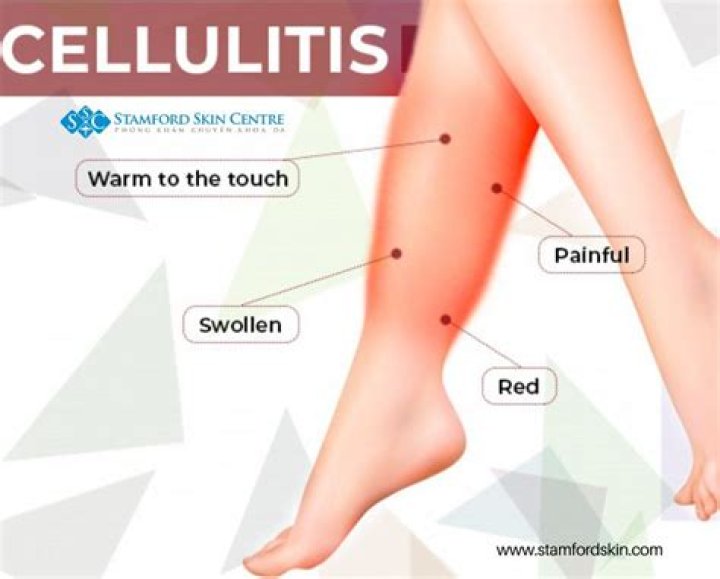 How do you get rid of cellulitis on legs?