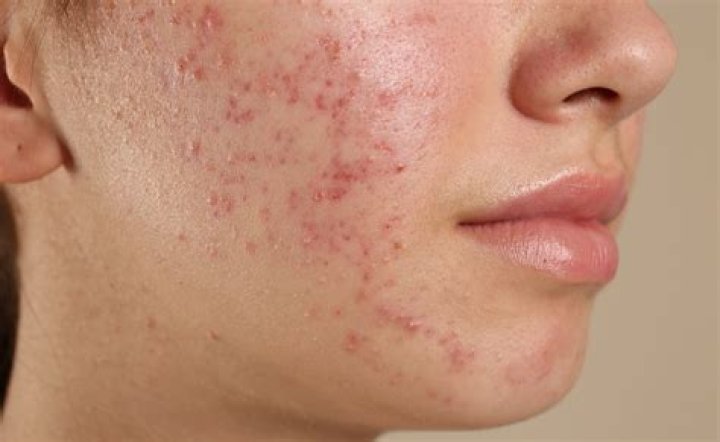 How do you get rid of teenage spots?