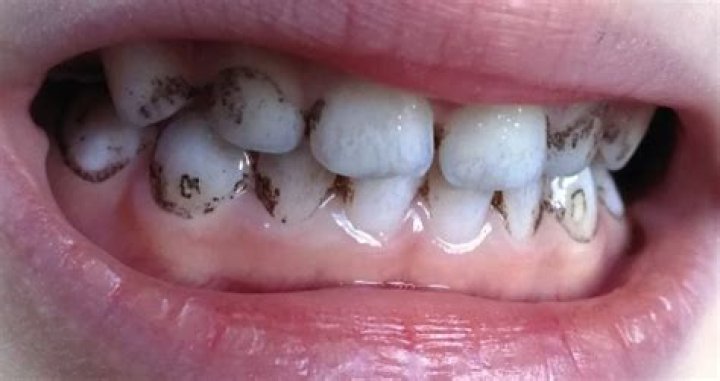 How do you get stains off vape teeth?