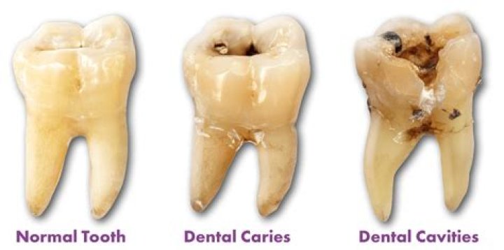 How do you identify a cavity?