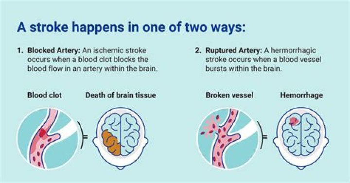 How do you know if a stroke is getting worse?