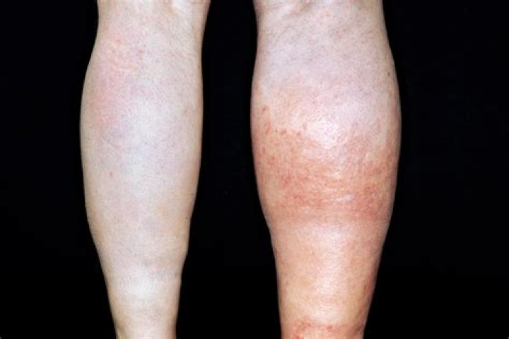 How do you know if you have a blood clot?