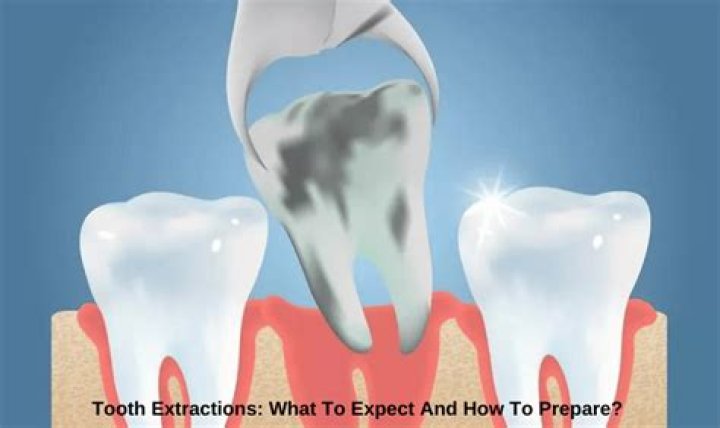 How do you prepare for multiple tooth extractions?
