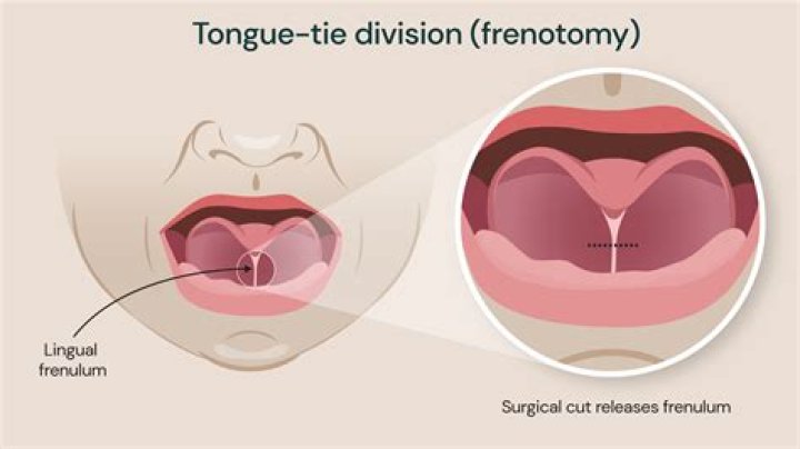 How do you prevent a tongue-tie from reattaching?