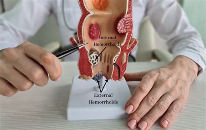 How do you shrink an external hemorrhoid fast?