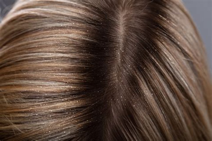 How do you tell if you have lice or dry scalp?