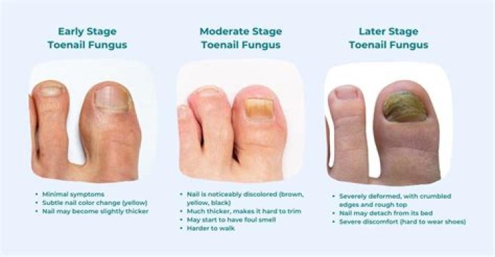 How does a person get toenail fungus?