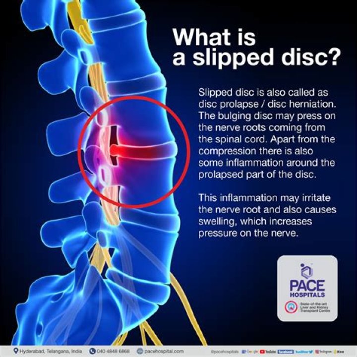 How does a slipped disc feel?