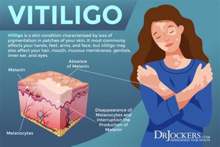How does vitiligo start off?