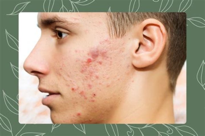 How does zinc clear acne?