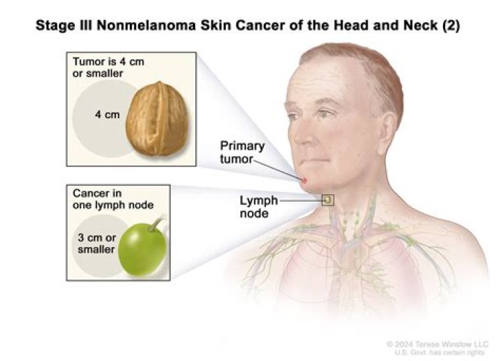 How hard is a cancerous lymph node?
