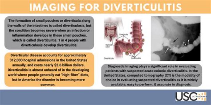 How long after diverticulitis can I have a colonoscopy?