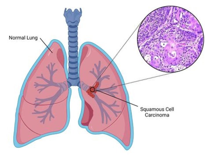 How long can you live with squamous cell carcinoma in lungs?
