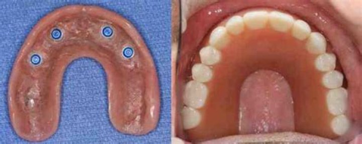 How long do snap-on dentures last?