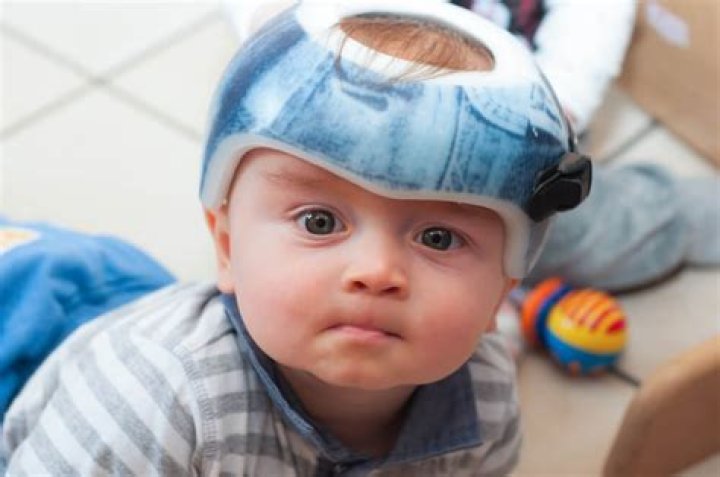 How long does helmet therapy take?