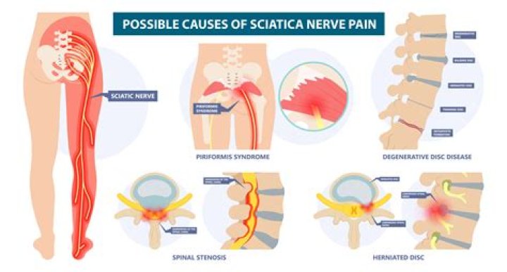 How long does it take a sciatic nerve to heal?