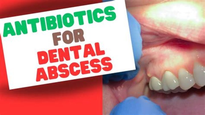 How long does it take for a tooth abscess to go away with antibiotics?