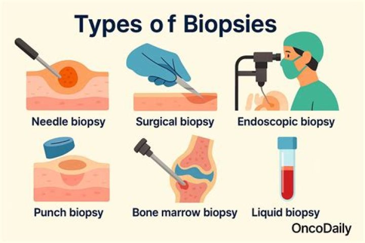 How long does it take to get the results of a needle biopsy?