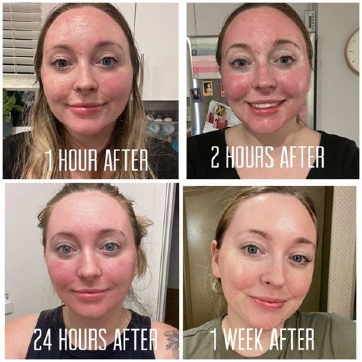 How long does it take to see Fraxel results?