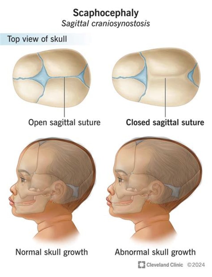How long is recovery after craniosynostosis surgery?