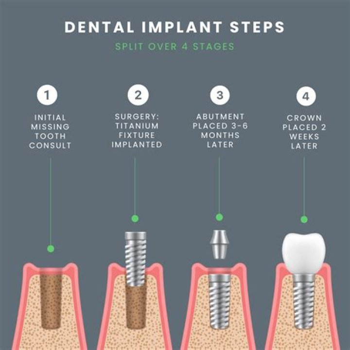 How long is recovery for tooth implant?