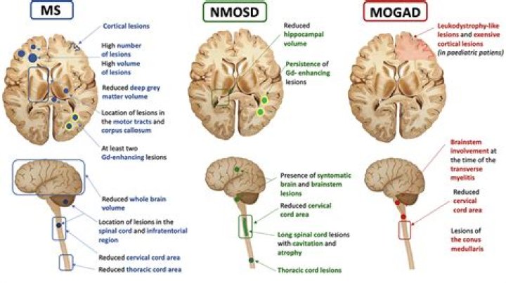 How many lesions is alot for MS?