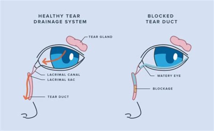 How much blockage requires a stent?