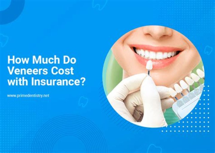 How much do veneers cost on top?
