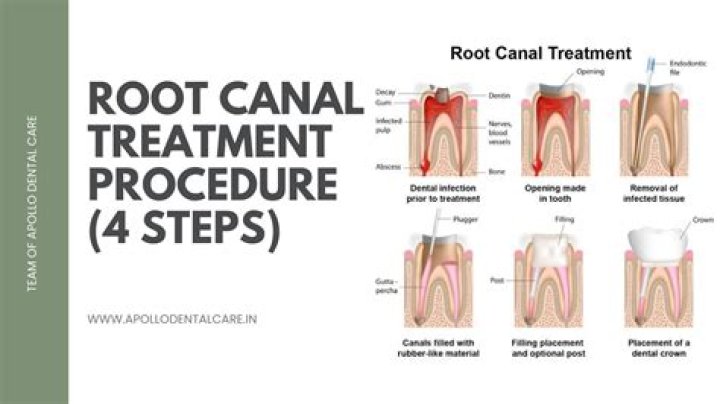 How much pain is there after a root canal retreatment?