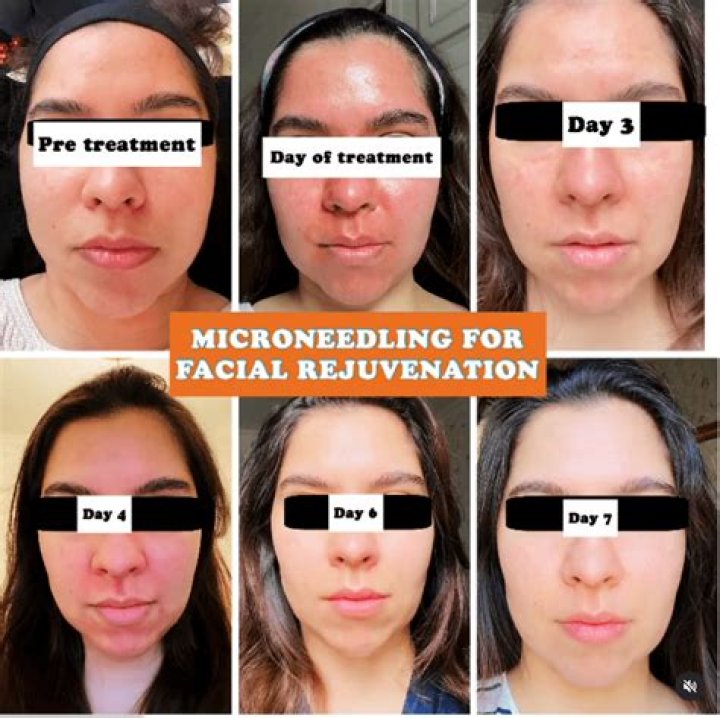 How often do you need micro needling?