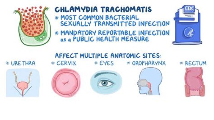 How serious is chlamydia?