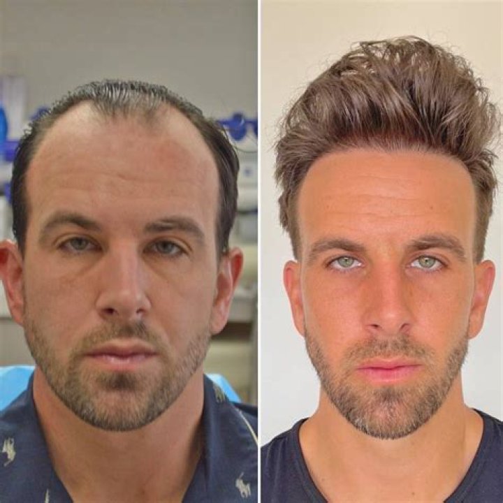 Is 30 a good age for hair transplant?
