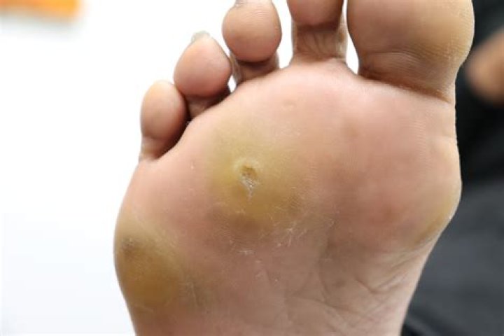 Is corn inflammatory?