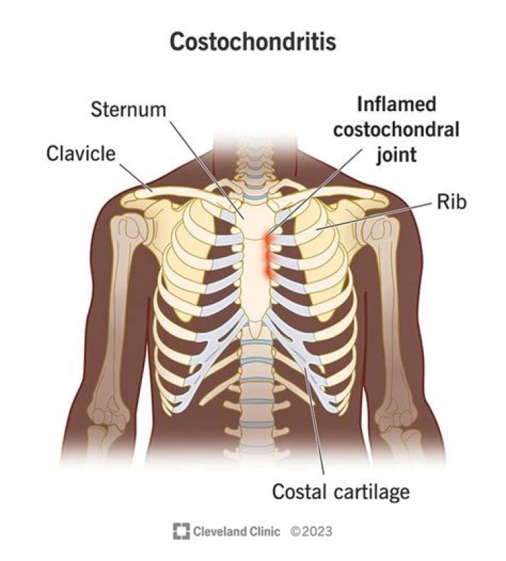 Is costochondritis serious?
