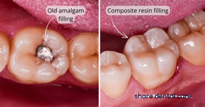 Is Fuji a composite filling?