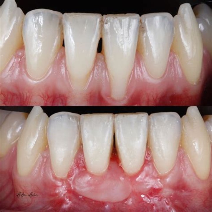 Is gum grafting permanent?