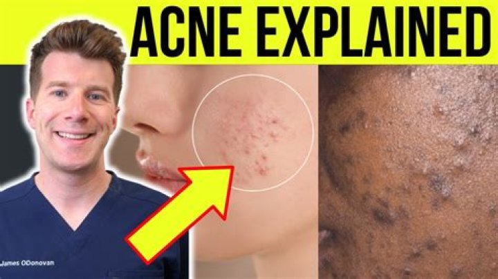 Is having acne good?