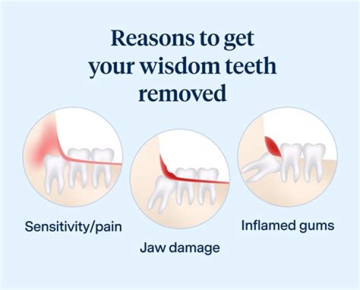 Is it good to remove all 4 wisdom teeth at once?