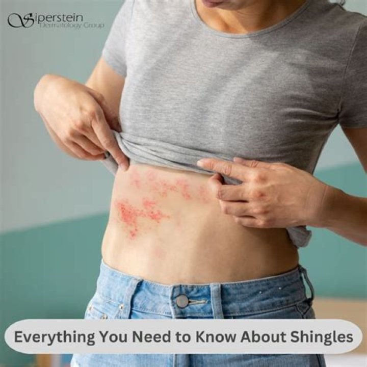 Is it OK to be around someone with shingles?